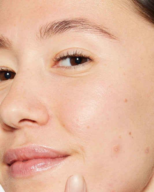 Pickel bei Erwachsenen und Teenagern: Die Unterschiede + was man gegen Unreinheiten machen kann