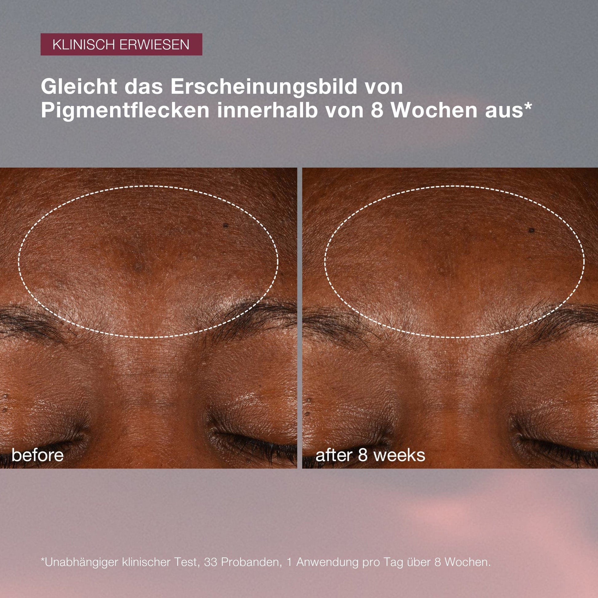 Vorher- und Nachher-Fotos, die die Verringerung der Pigmentierung auf der Stirn hervorhebt